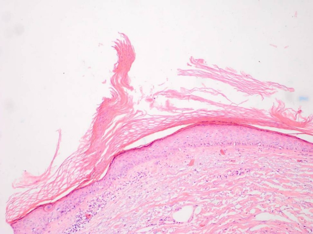 Het histologische kenmerk van porokeratose is een cornoid lamel. Dit is een verticale en uitwaaierende hoornplaat die zich uitstrekt boven het huidoppervlak