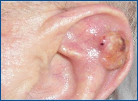 Plaveiselcelcarcinoom op het oor