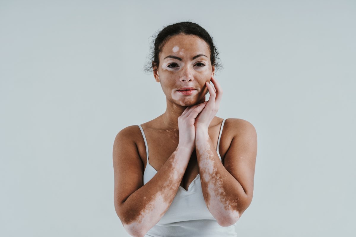 vitiligo