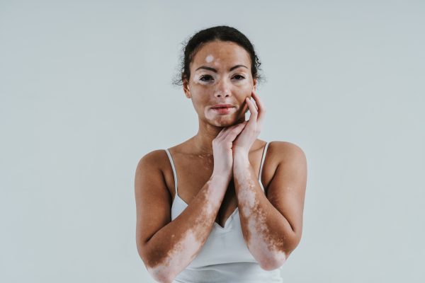 vitiligo
