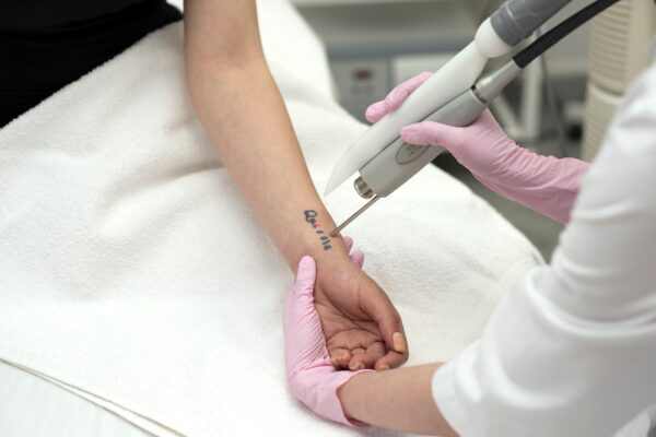 tatoeage verwijderen